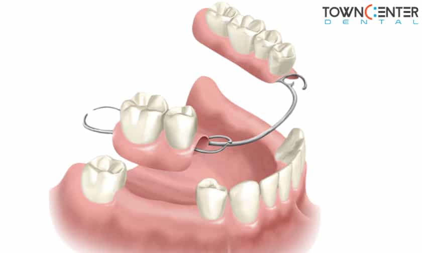 Dental Bridges in Cedar Park