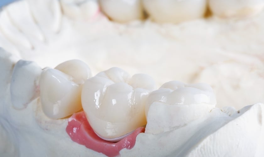 Dental Crowns in Cedar Park TX