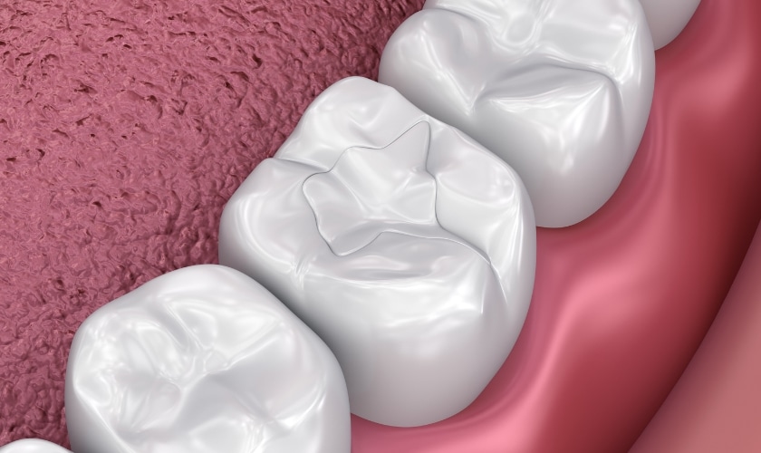 Dental Fillings in Cedar Park TX