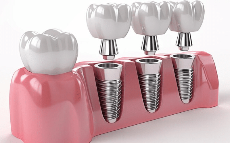 How Long Dental Implants Last