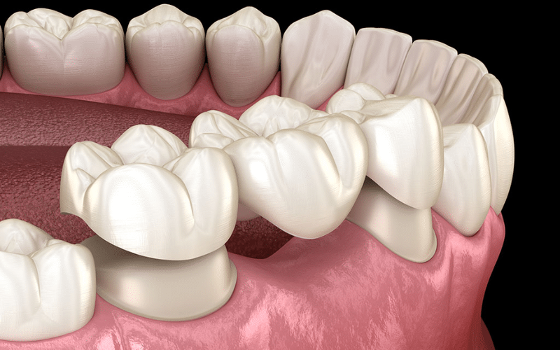 Dental Crowns and Bridges