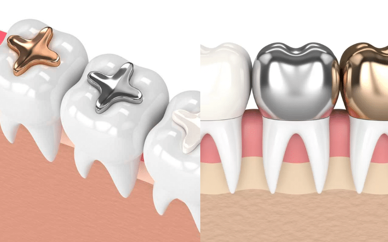 Is Lost Filling Or Crown A Dental Emergency